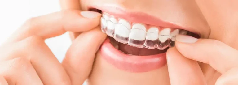 ارتودنسی نامرئی